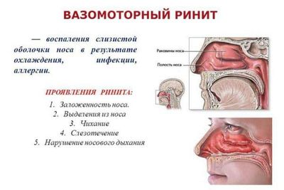 vazomotornyj-rinit
