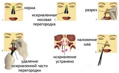 Оперативное лечение искривления носовой перегородки