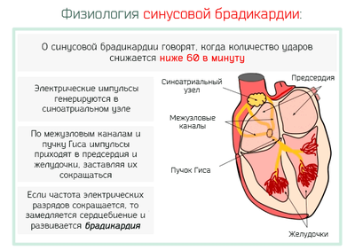 Брадикардия