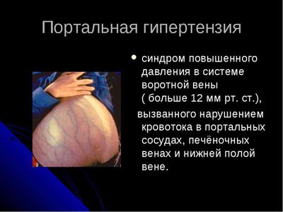 Портальная гипертензия