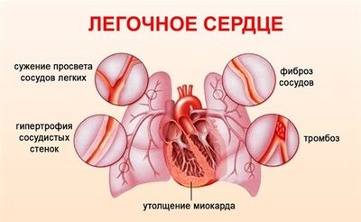 Легочное сердце