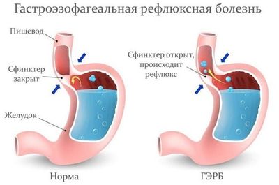 Изжога