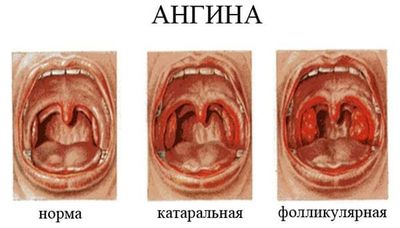 разновидности ангины