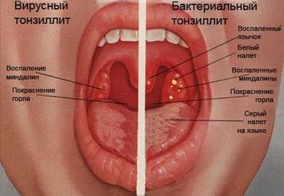 симптомы ангины