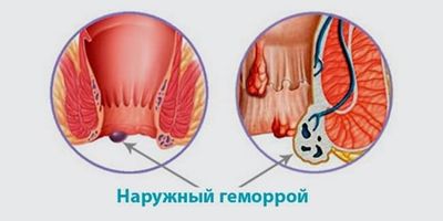 Наружный геморрой
