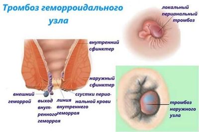Тромбоз