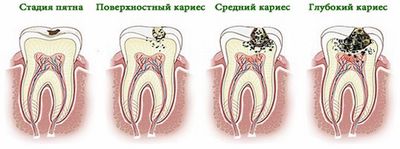 Стадии развития кариеса