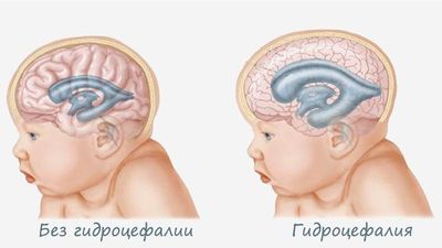 Симптомы водянки головного мозга (гидроцефалии) у новорожденных