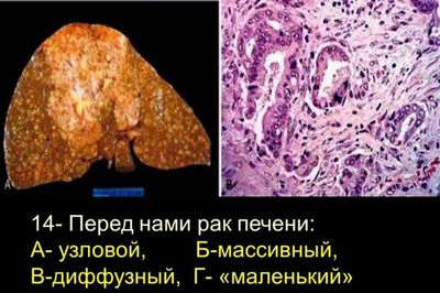 Изменения в печени