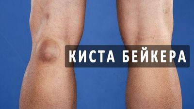 Киста Бейкера: причины появления, симптоматика, методы лечения