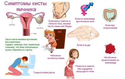 синдром кисты яичника