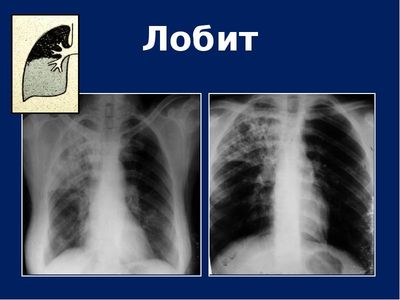 Туберкулезный лобит