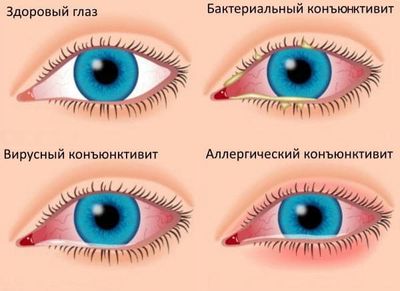 виды конъюнктивита