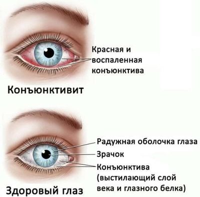 определение конъюнктивита