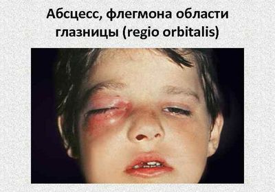 Абсцесс глазницы
