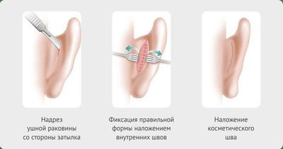 Как проходит операция отопластика лазерная, реабилитационный период и уход после