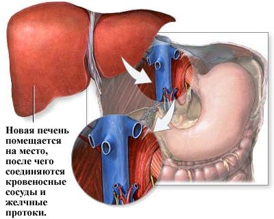 Пересадка печени