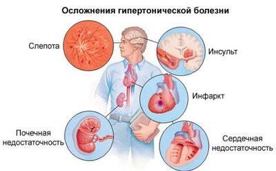Осложнения артериальной гипертензии