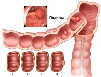 Полипы