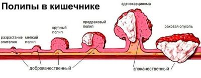 Полипы в кишечнике