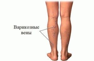 Лечение варикоза вен на ногах