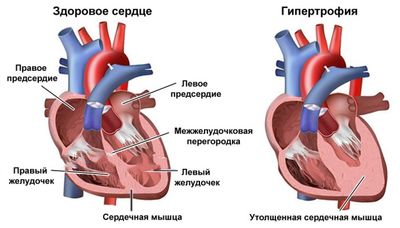 Гипертрофия миокарда