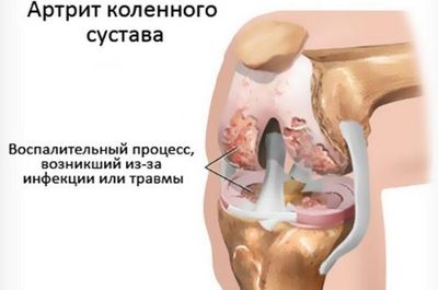 Артрит