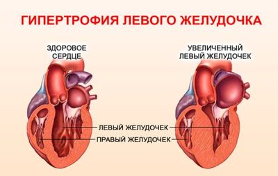 Гипертрофия ЛЖ