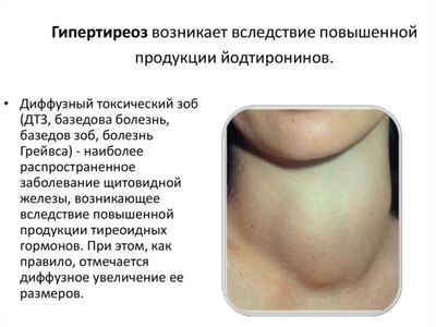 Гипертиреоз