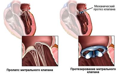 Вальвулопластика митрального клапана