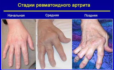ревматоидный артрит