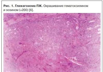 Глюкагонома