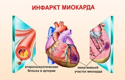 Нижний инфаркт миокарда