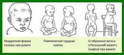 Признаки рахита у детей