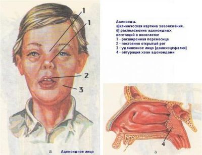 priznaki-adenoidita-u-detej