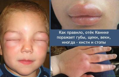 Отек Квинке: симптомы у детей, как оказать первую помощь