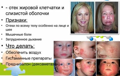 Отек Квинке: симптомы у детей, как оказать первую помощь 1