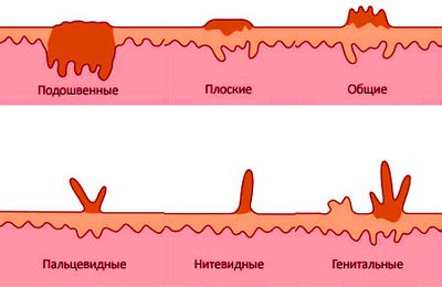 виды папиллом
