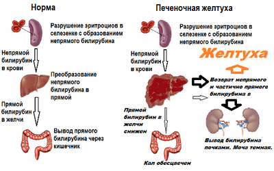 Печеночная желтуха