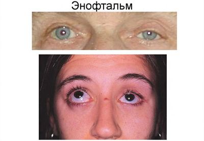 Симптомы энофтальма