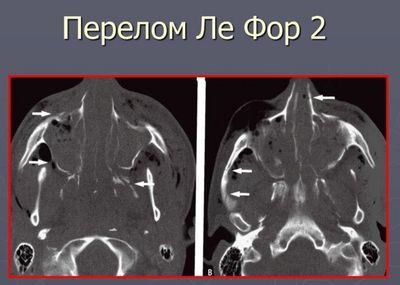 Перелом по Лефору 2