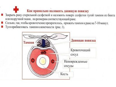 Давящая повязка