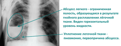 abscess-legkogo