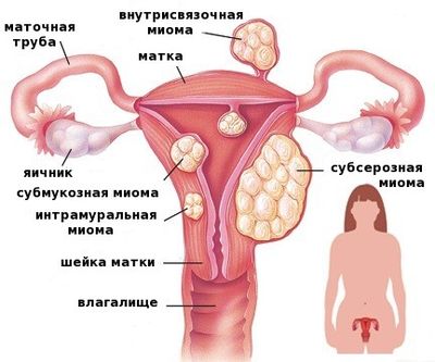 Полостная операция миома матки