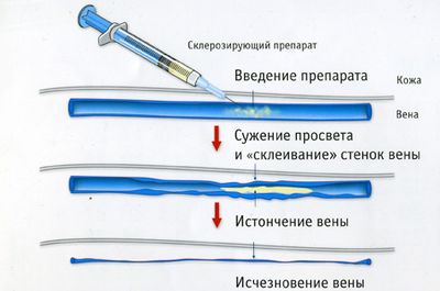 Склеротерапия