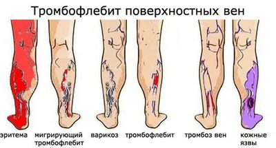 Поверхностный тромбофлебит