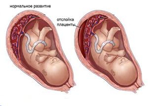 Почему преждевременно стареет плацента