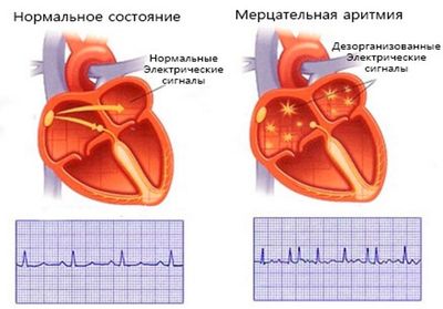 особенность мерцательной аритмии