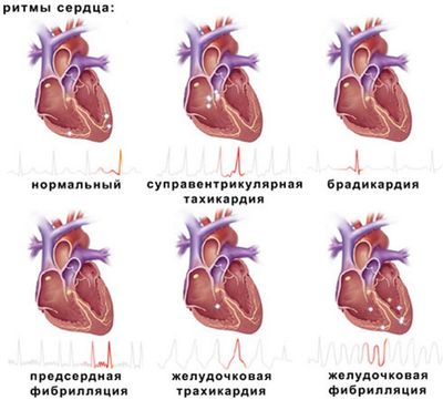 ритмы сердца
