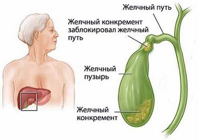Желчнокаменная болезнь